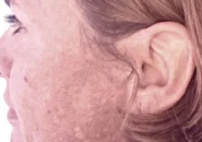 Bio Microneedeling