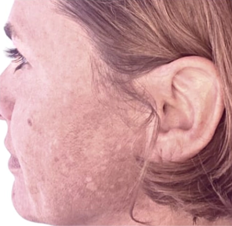 Bio Microneedeling