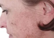 Bio Microneedeling