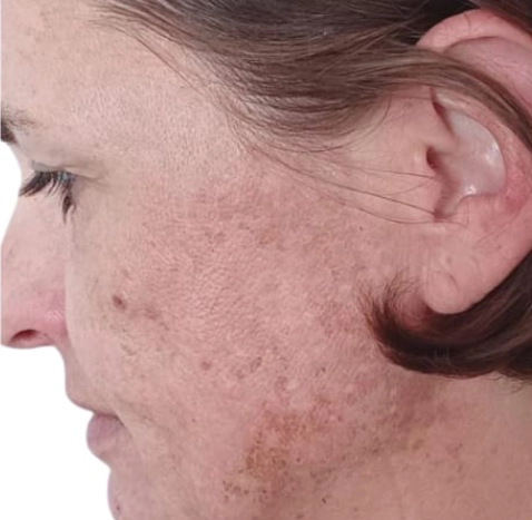 Bio Microneedeling