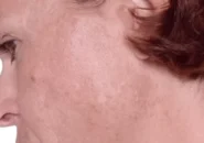 Bio Microneedeling