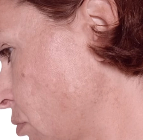 Bio Microneedeling