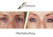 oberlidstraffung