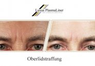 oberlidstraffung-mann